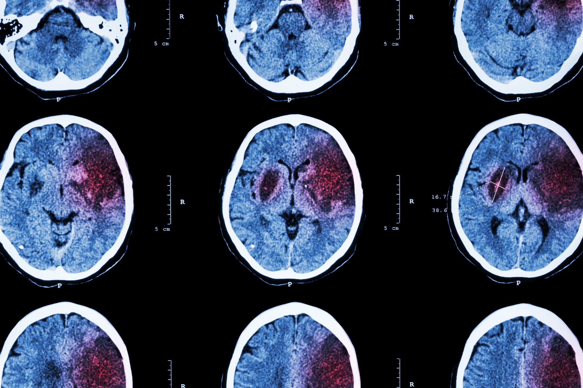 Ischemic stroke. CT scan of brain showing cerebral infarction